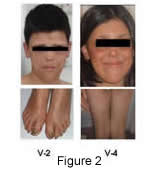  PN Phenotype: Affected proband (V-2) and sib (V-4) at age 22 and 14 showing facial poikiloderma extending to buttocks and legs and pachyonychia of the toes.